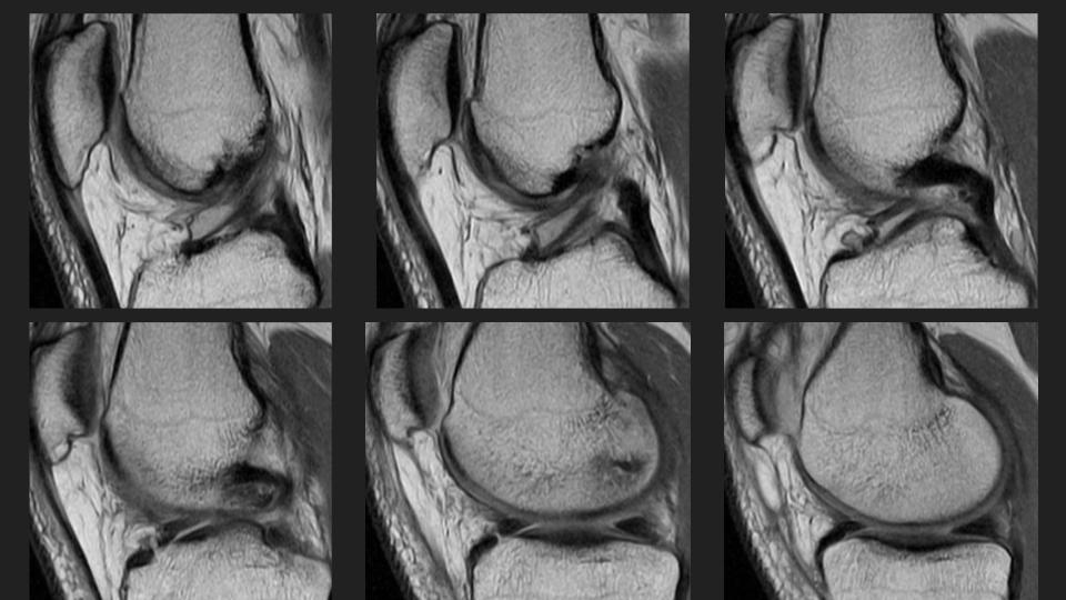 Figure 1 for case meniscofemoral ligament ( RID2806 )